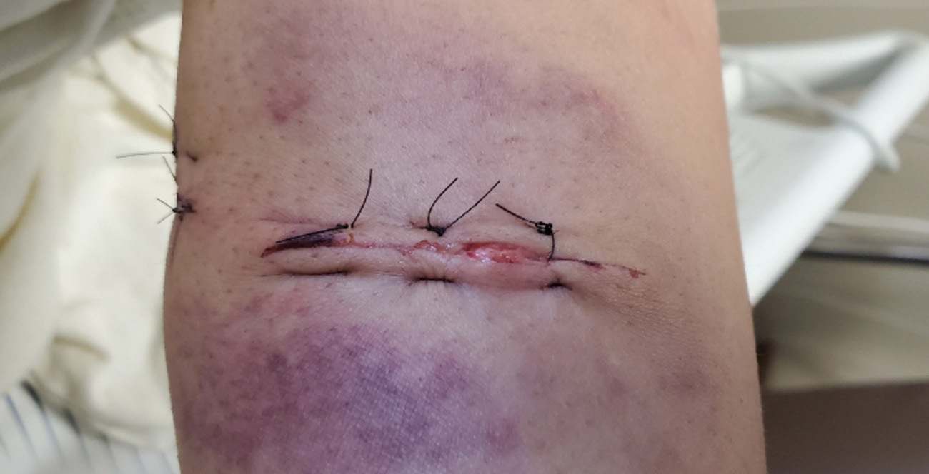 An image of Bates' left forearm showing a wound sewn up with stitches.