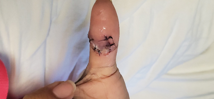 A photo of Bates' right thumb, with stitches.