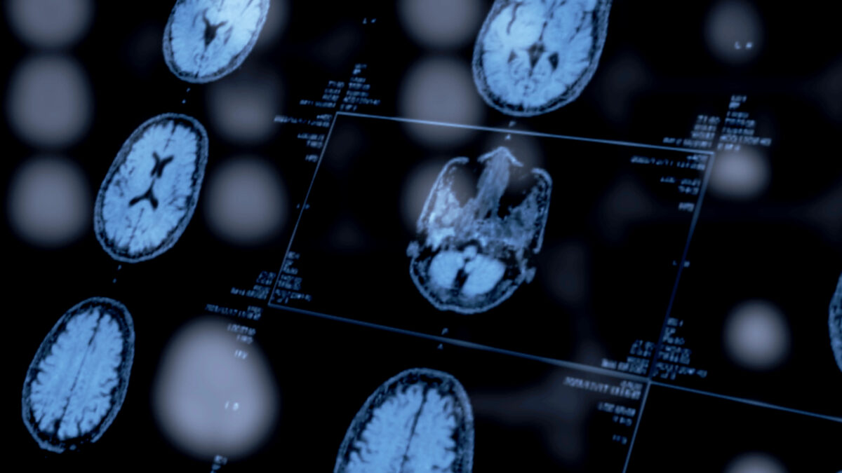 An image of several brain scans on a screen.