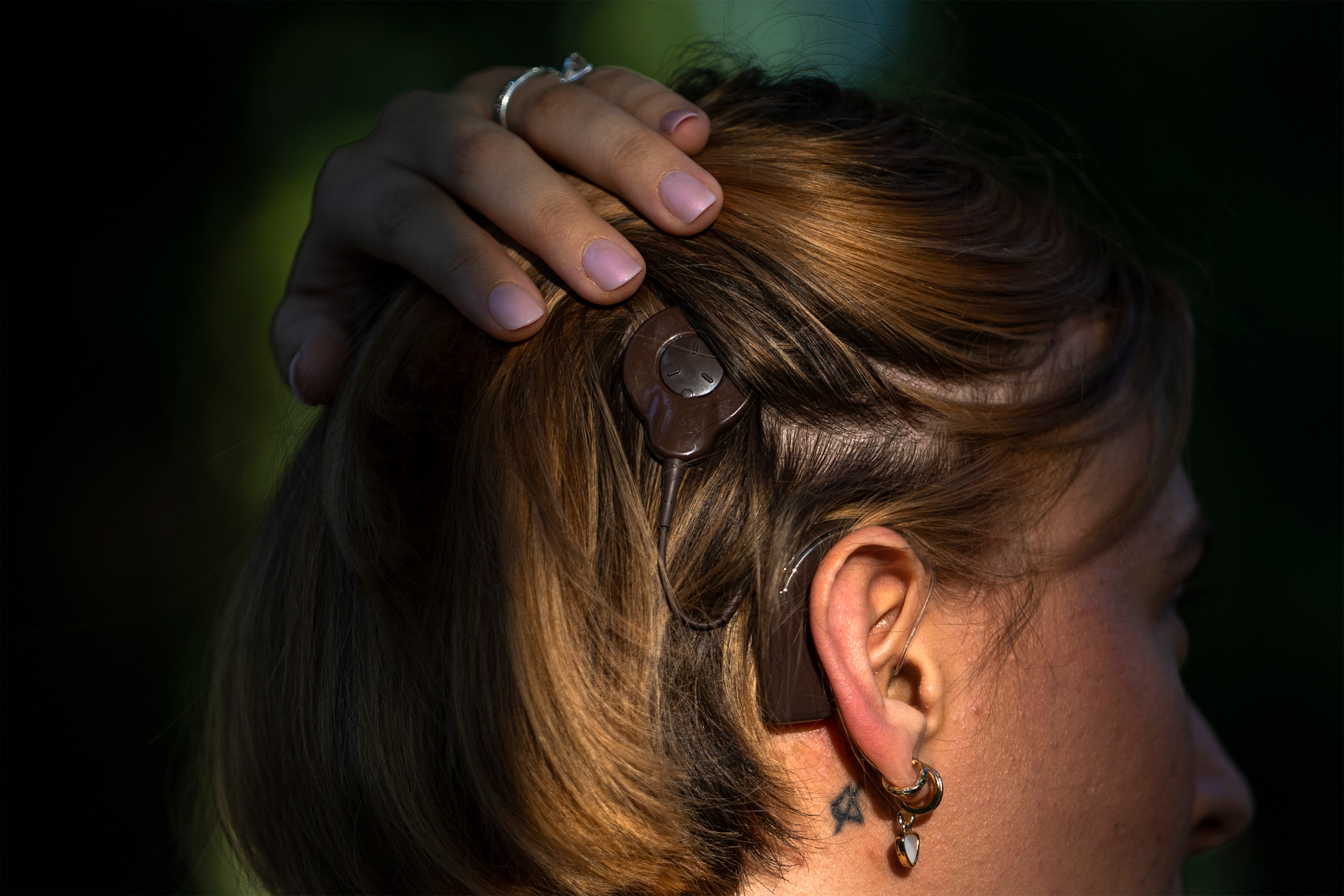 july_botm_mai_11-resized A photo of the back of Mai's heading, showing her hearing device implant.