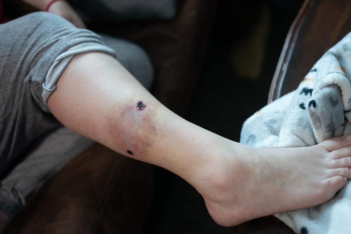 kansas-city-victims-money-gooch-tavis-08 A photo Emily Tavis' leg. There's a gunshot wound on the side of her shin. You can see where the bullet entered and exited her body.