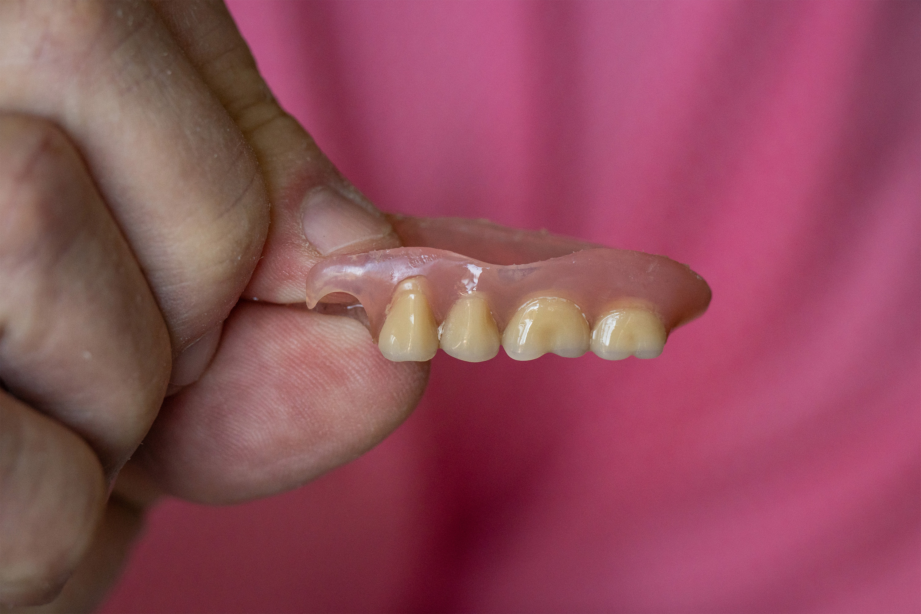 moske_16-resized A photo of a hand holding up a partial denture.
